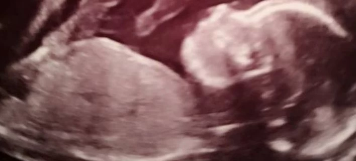 Πρωτοποριακή επέμβαση: Εβγαλαν έμβρυο από τη μήτρα, το εγχείρησαν και το ξανάβαλαν στη θέση του!